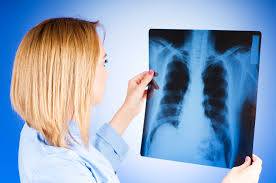 Медики назвали найбільш хворі на туберкульоз райони Чернігівщини